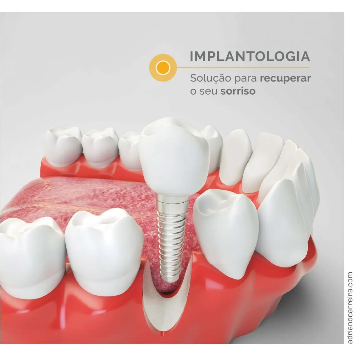 Implantologia: Etapas do Tratamento