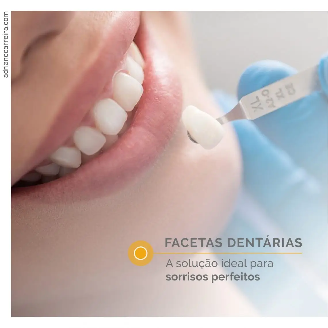Facetas Dentárias: O Sorriso que sempre sonhou. Saiba como Facetas Dentárias: O Sorriso que sempre sonhou. Saiba como